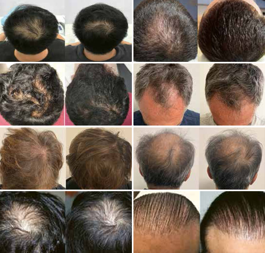 Stimulate Natural Regrowth With Laser Hair Restoration