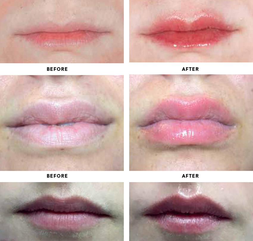 Achieve More Defined Lips Without Fillers