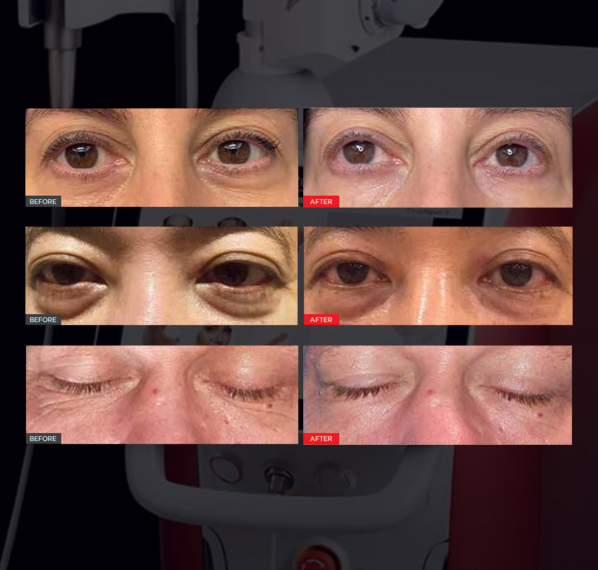 Brighten and Refresh Tired-Looking Eyes