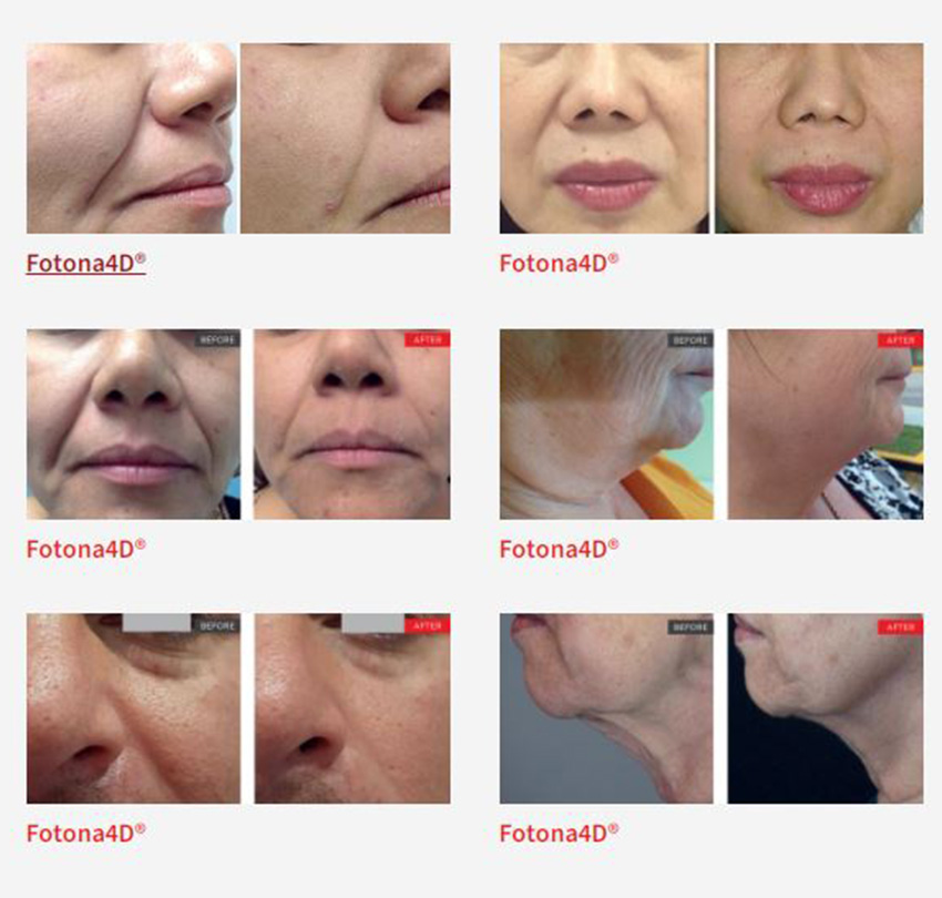 Gain the Ultimate Non-Surgical Facelift